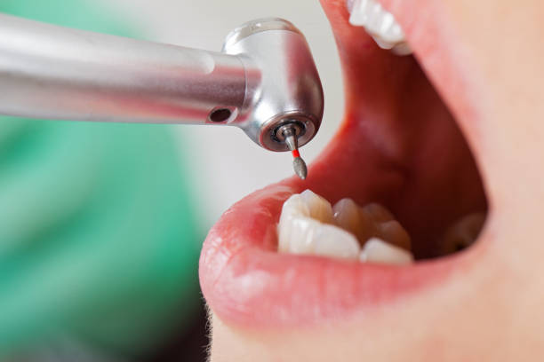Best Emergency Tooth Extraction in Pepper Pike, OH